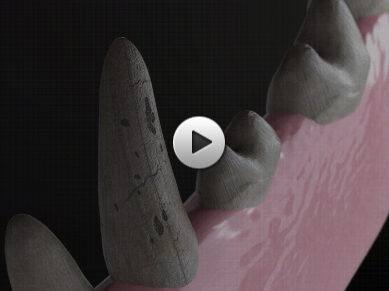 치아 스크레치, 미네랄 보호층 생성